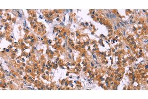 Immunohistochemistry of paraffin-embedded Human thyroid cancer tissue using MSMO1 Polyclonal Antibody at dilution 1:40