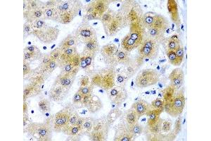 Immunohistochemistry of paraffin-embedded Human liver damage using SECISBP2 Polyclonal Antibody at dilution of 1:200 (40x lens).