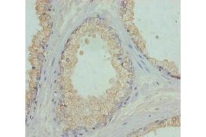 Immunohistochemistry of paraffin-embedded human prostate cancer using ABIN7152449 at dilution of 1:100 (FBXO7 Antikörper  (AA 353-522))