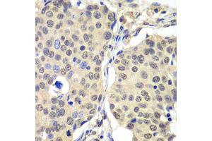 Immunohistochemistry of paraffin-embedded human lung cancer using CCNC antibody (ABIN5973928) at dilution of 1/100 (40x lens). (Cyclin C Antikörper)
