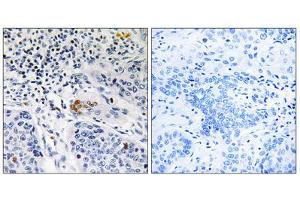 Immunohistochemistry analysis of paraffin-embedded human lung carcinoma tissue, using ZBTB40 antibody. (ZBTB40 Antikörper  (C-Term))