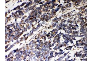 Anti-Peroxiredoxin 5 Picoband antibody, (ABIN3043906), IHC(P)IHC(P): Human Lung Cancer Tissue (Peroxiredoxin 5 Antikörper  (AA 66-198))