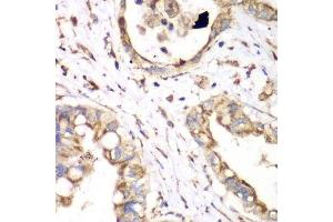 Immunohistochemistry of paraffin-embedded human liver cancer using HADHA antibody. (HADHA Antikörper  (AA 484-763))