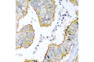 Immunohistochemistry of paraffin-embedded human colon carcinoma using KRBOX4 antibody (ABIN5975027) at dilution of 1/200 (40x lens).