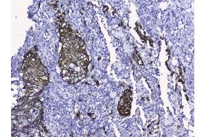 IHC analysis of Cytokeratin 19 using anti-Cytokeratin 19 antibody (ABIN3043288).