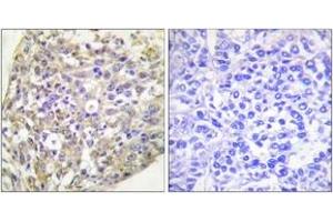 Immunohistochemistry analysis of paraffin-embedded human breast carcinoma, using HSP90B (Phospho-Ser254) Antibody. (HSP90AB1 Antikörper  (pSer254))