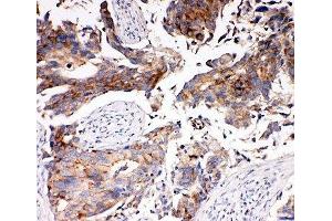 IHC-P: MCT5 antibody testing of human breast cancer tissue (SLC16A4 Antikörper  (N-Term))