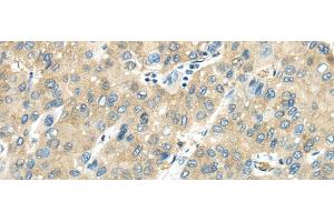 Immunohistochemistry of paraffin-embedded Human liver cancer tissue using VPS4A Polyclonal Antibody at dilution 1:40