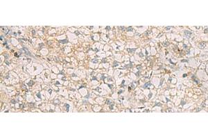 Immunohistochemistry of paraffin-embedded Human liver cancer tissue using SLC30A6 Polyclonal Antibody at dilution of 1:70(x200) (SLC30A6 Antikörper)