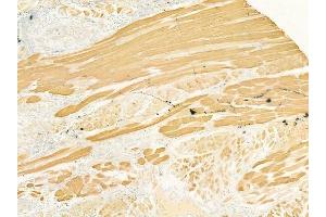 ABIN6260166 and ABIN6277547 at 1/100 staining human tongue carcinoma by IHC-P.