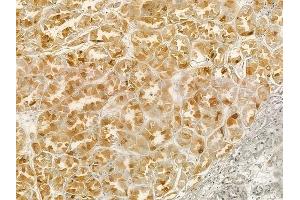 ABIN6258842 and ABIN6274149 at 1/100 staining human renal cell carcinoma by IHC-P. (HMGN2 Antikörper  (Internal Region))