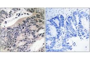 Immunohistochemistry analysis of paraffin-embedded human colon carcinoma tissue, using ACSS1 Antibody. (ACSS1 Antikörper)
