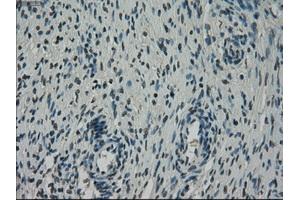 Immunohistochemical staining of paraffin-embedded Adenocarcinoma of breast tissue using anti-NEK6 mouse monoclonal antibody.