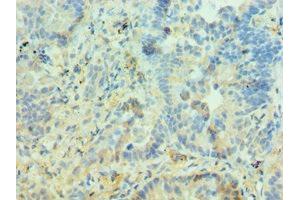 Immunohistochemistry of paraffin-embedded human lung cancer using ABIN7150969 at dilution of 1:100 (PIAS3 Antikörper  (AA 399-628))