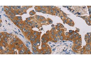 Immunohistochemistry of paraffin-embedded Human cervical cancer tissue using MBNL3 Polyclonal Antibody at dilution 1:30