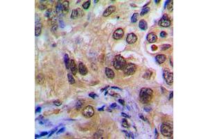 Immunohistochemical analysis of POTEA staining in human breast cancer formalin fixed paraffin embedded tissue section.