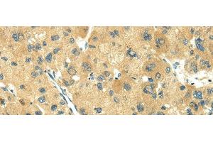 Immunohistochemistry of paraffin-embedded Human liver cancer using TRIM10 Polyclonal Antibody at dilution of 1/35