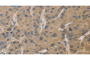 Immunohistochemistry of paraffin-embedded Human liver cancer tissue using TBXAS1 Polyclonal Antibody at dilution 1:30 (TBXAS1 Antikörper)