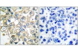 Immunohistochemistry analysis of paraffin-embedded human breast carcinoma tissue, using FGFR1 Oncogene Partner Antibody. (FGFR1OP Antikörper  (AA 341-390))