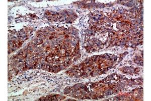 Immunohistochemical analysis of paraffin-embedded human-lung-cancer, antibody was diluted at 1:200 (MLL/KMT2A Antikörper  (AA 3850-3900))