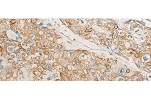 Immunohistochemistry of paraffin-embedded Human prost at e cancer tissue using HLA-DMB Polyclonal Antibody at dilution of 1:40(x200) (HLA-DMB Antikörper)