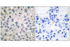 Immunohistochemical analysis of paraffin-embedded human breast carcinoma tissue, using Catenin- alpha antibody. (CTNNA1 Antikörper  (C-Term))