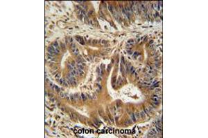 VPS52 antibody immunohistochemistry analysis in formalin fixed and paraffin embedded human colon carcinoma followed by peroxidase conjugation of the secondary antibody and DAB staining.