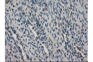 Immunohistochemical staining of paraffin-embedded Adenocarcinoma of breast tissue using anti-STK39 mouse monoclonal antibody. (STK39 Antikörper)