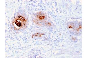 Formalin-fixed, paraffin-embedded human Breast Carcinoma stained with TAG-72 Recombinant Mouse Monoclonal Antibody (rB72. (Rekombinanter TAG-72 / CA72.4 Antikörper)