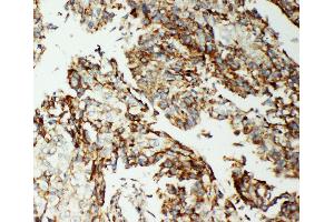 Anti-AIF antibody, IHC(P) IHC(P): Human Lung Cancer Tissue (AIF Antikörper  (C-Term))