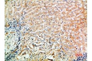 Immunohistochemical analysis of paraffin-embedded human-liver-cancer, antibody was diluted at 1:200 (WISP3 Antikörper  (AA 1-50))