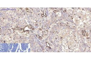 Immunohistochemistry of paraffin-embedded Human lung cancer tissue using CD45 Monoclonal Antibody at dilution of 1:200. (CD45 Antikörper)
