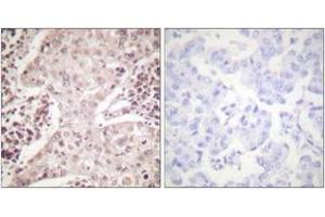 Immunohistochemistry analysis of paraffin-embedded human breast carcinoma, using Chk2 (Ab-387) Antibody. (CHEK2 Antikörper  (AA 361-410))