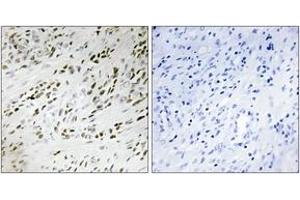 Immunohistochemistry analysis of paraffin-embedded human prostate carcinoma tissue, using TSH2 Antibody. (THNSL2 Antikörper  (AA 811-860))