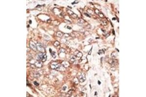 Formalin-fixed and paraffin-embedded human cancer tissue reacted with the primary antibody, which was peroxidase-conjugated to the secondary antibody, followed by DAB staining. (TPX2 Antikörper  (AA 350-382))