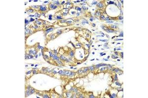 Immunohistochemistry of paraffin-embedded human gastric cancer using AK2 antibody. (Adenylate Kinase 2 Antikörper  (AA 1-232))