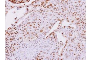 IHC-P Image Carboxypeptidase E antibody [N2C2], Internal detects Carboxypeptidase E protein at nucleus on human breast cancer by immunohistochemical analysis. (CPE Antikörper)