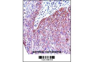 KRT6B Antibody immunohistochemistry analysis in formalin fixed and paraffin embedded human cervical carcinoma followed by peroxidase conjugation of the secondary antibody and DAB staining. (Keratin 6B Antikörper  (AA 207-236))