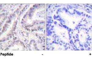 Immunohistochemical analysis of paraffin-embedded human lung carcinoma tissue using CDC6 polyclonal antibody . (CDC6 Antikörper)