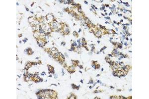 Immunohistochemistry of paraffin-embedded Human breast cancer using DHRS2 Polyclonal Antibody at dilution of 1:100 (40x lens). (DHRS2 Antikörper)