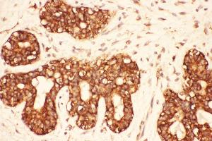 Anti-Src Picoband antibody,  IHC(P): Human Mammary Cancer Tissue (Src Antikörper  (AA 2-368))