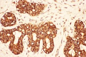 Anti-Src Picoband antibody,  IHC(P): Human Mammary Cancer Tissue