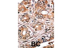 Formalin-fixed and paraffin-embedded human cancer tissue reacted with the primary antibody, which was peroxidase-conjugated to the secondary antibody, followed by AEC staining. (Retinoblastoma 1 Antikörper  (pSer780))