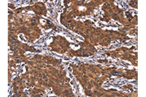 The image on the left is immunohistochemistry of paraffin-embedded Human gastric cancer tissue using ABIN7191188(KCNJ9 Antibody) at dilution 1/15, on the right is treated with synthetic peptide. (KCNJ9 Antikörper)