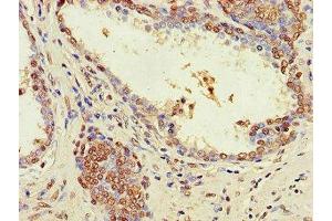 Immunohistochemistry of paraffin-embedded human prostate cancer using ABIN7176555 at dilution of 1:100 (ZNF844 Antikörper  (AA 1-300))