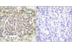 Immunohistochemistry analysis of paraffin-embedded human breast carcinoma tissue, using Shc (Ab-349) Antibody. (SHC1 Antikörper  (AA 315-364))