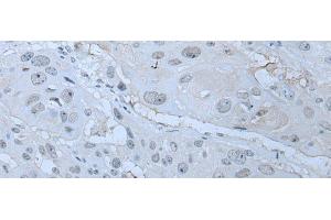Immunohistochemistry of paraffin-embedded Human esophagus cancer tissue using HUWE1 Polyclonal Antibody at dilution of 1:30(x200) (HUWE1 Antikörper)