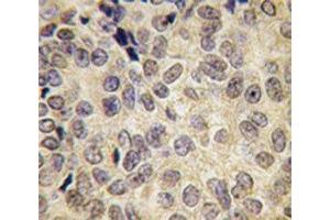 IHC analysis of FFPE human prostate carcinoma tissue stained with Dnmt3b antibody (DNMT3B Antikörper  (AA 389-417))