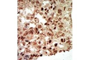 Formalin-fixed and paraffin-embedded human cancer tissue (breast carcinoma) reacted with the primary antibody, which was peroxidase-conjugated to the secondary antibody, followed by AEC staining. (MAPK11 Antikörper  (Middle Region))