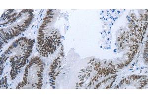 Immunohistochemistry of paraffin-embedded Human colon cancer tissue using RBMS1 Polyclonal Antibody at dilution 1:30 (RBMS1 Antikörper)